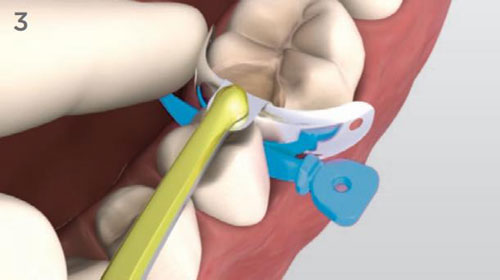 Матрицы Palodent Dentsply