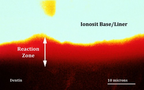 Между Ionosit-Baseliner и дентином возникает видимая "реакционная зона" без зазоров.
