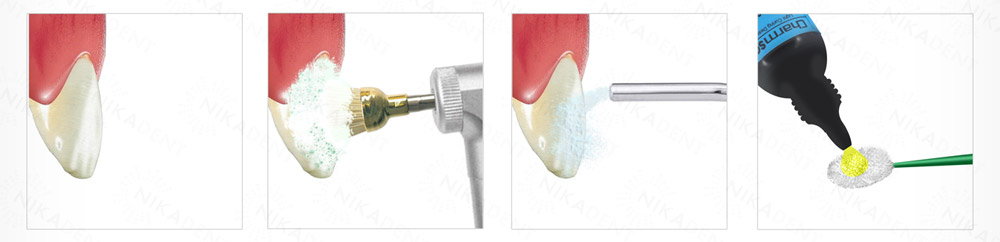 CharmSensy светоотверждаемая система снижения гиперчувствительности зубов.