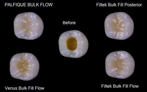 Estelite Bulk Fill Flow